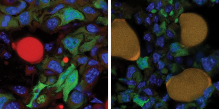 Progress Made Into Conversion of Breast Cancer Cells Into Fat Cells